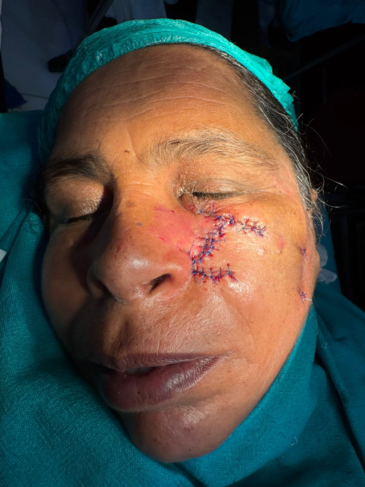 ✨ Expert Removal of Basal Cell Carcinoma: Precision & Care ✨