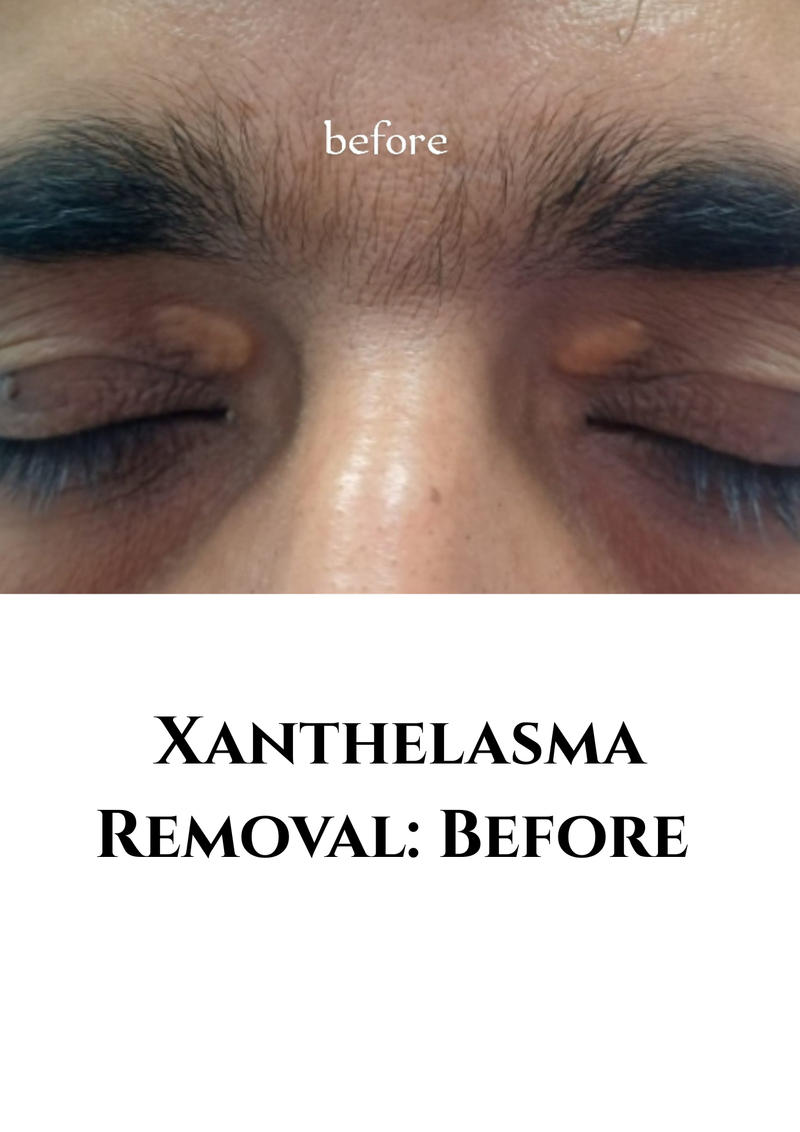 Xanthelasma