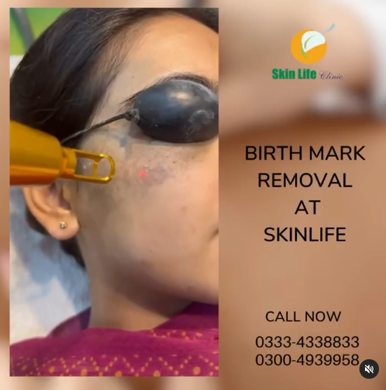 π Say Goodbye to Birthmarks with Dr. Tahir Kamal at Skin Life Clinic! π