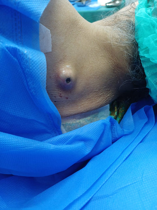 Excision of Epidermoid Cyst from the Nape of Neck – Dr. Tahir Kamal | Skin Life & Aesthetic Clinic