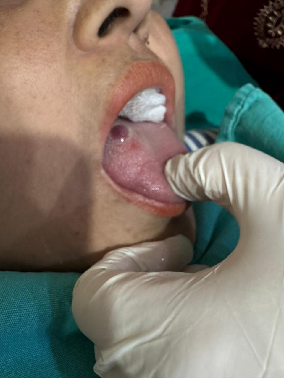 Effective Treatment for Vascular Growth on Tongue by Dr. Tahir Kamal