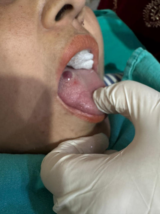 Effective Treatment for Vascular Growth on Tongue by Dr. Tahir Kamal