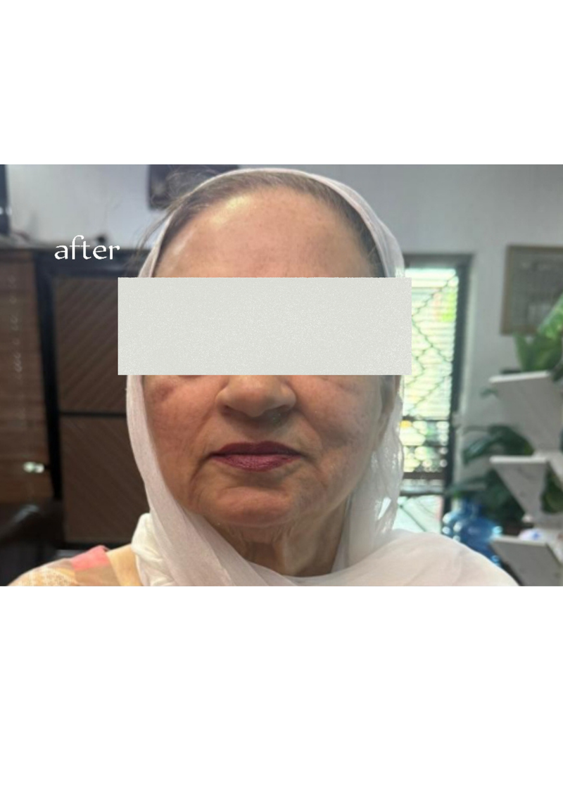 Thread Face Lift + Botox & Fillers