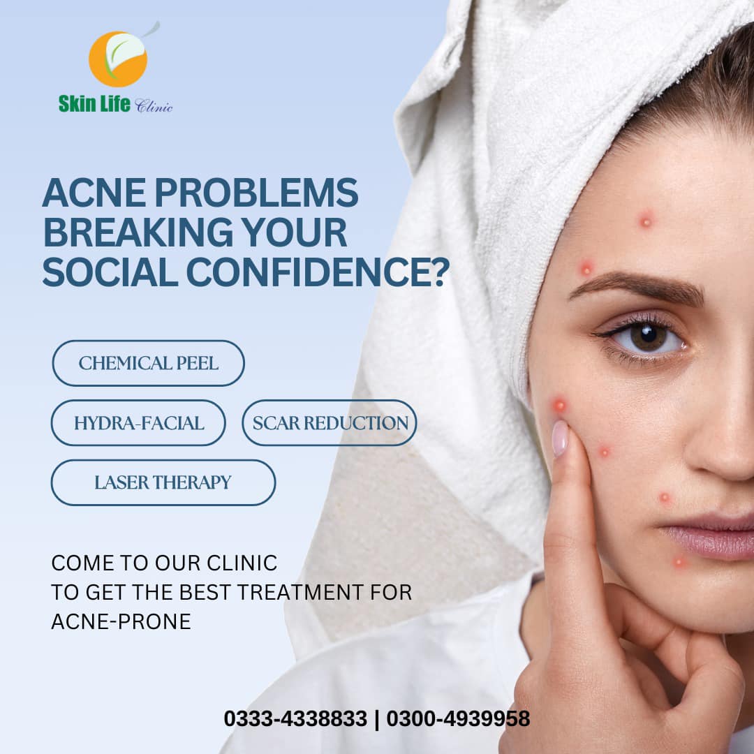 Acne Scars Removal