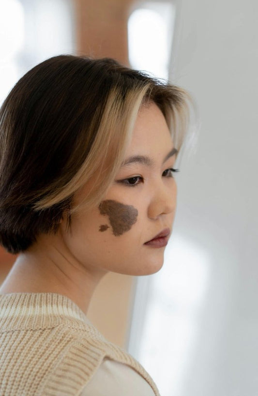 Birthmark Removal