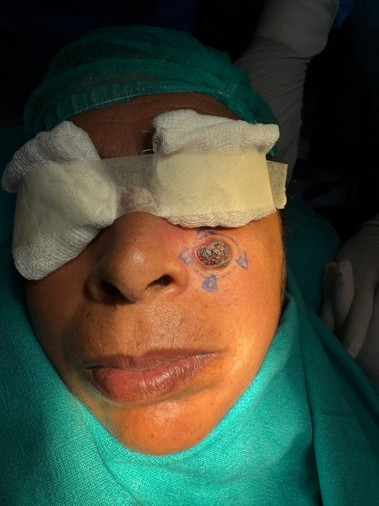 ✨ Expert Removal of Basal Cell Carcinoma: Precision & Care ✨