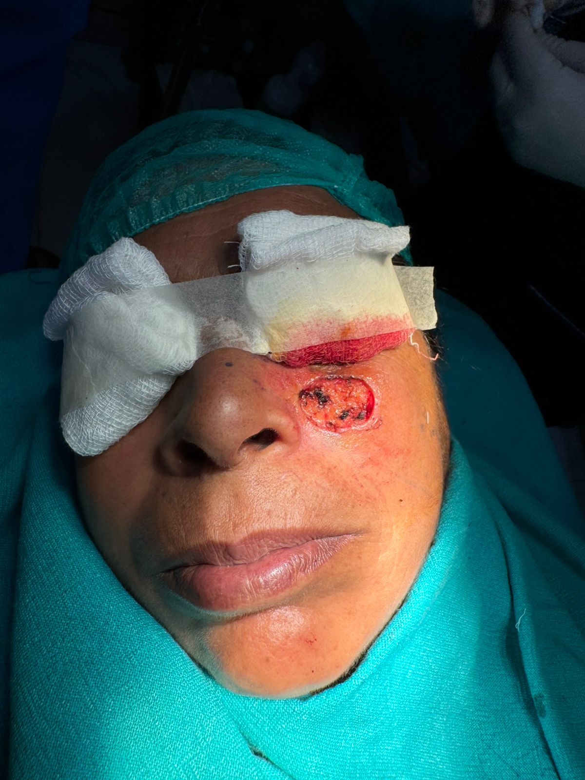 ✨ Expert Removal of Basal Cell Carcinoma: Precision & Care ✨