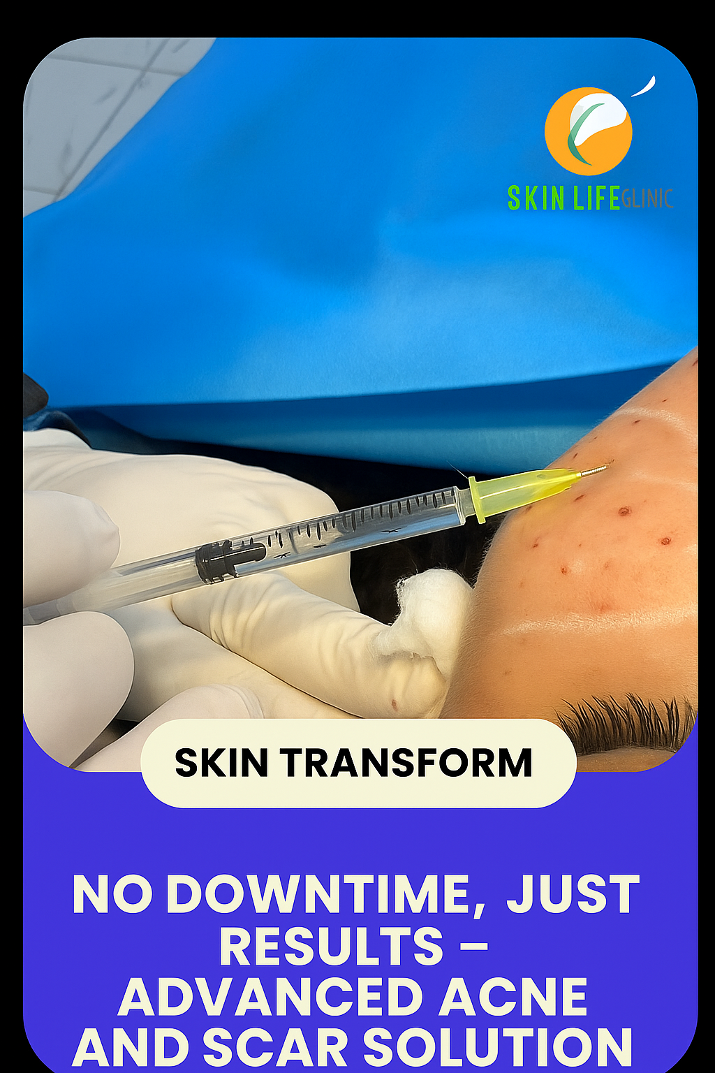 No Downtime, Just Results – Advanced Acne and Scar Solution