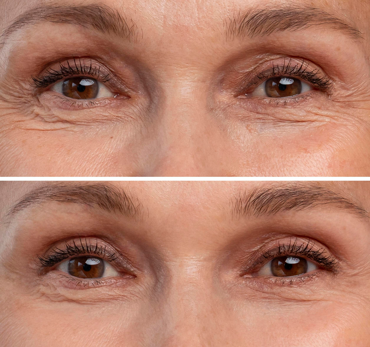Eyebags Treatments