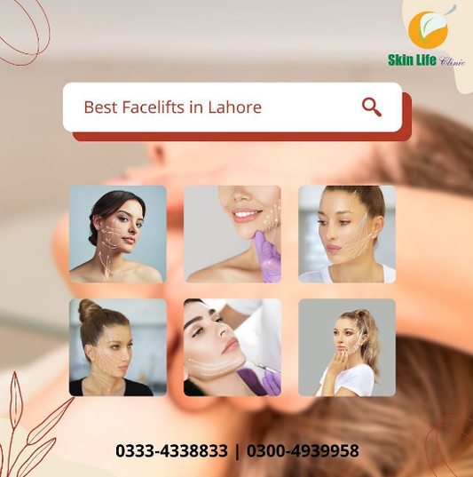 Face Lifts with Laser