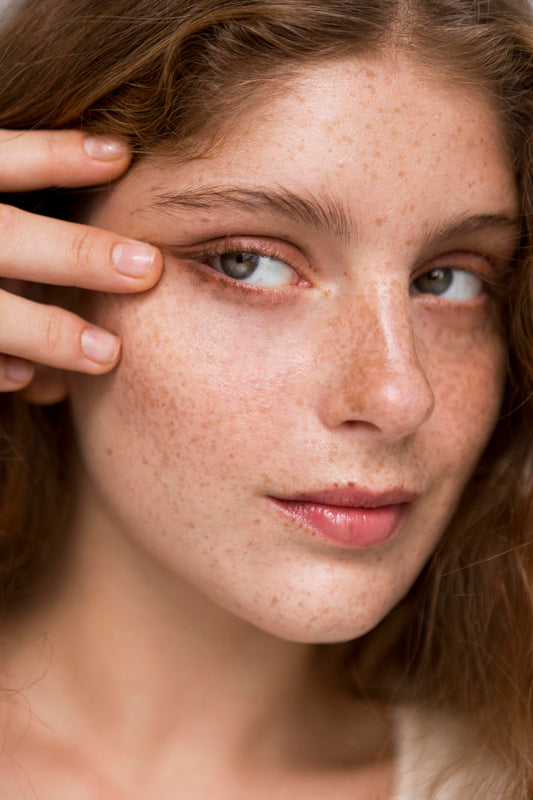 Freckles Removal