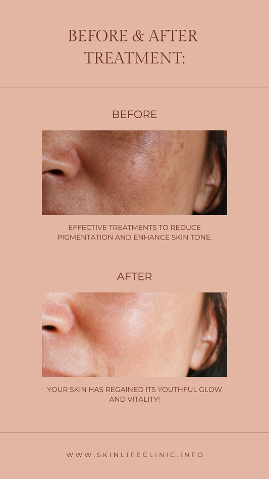 Pigmentation Treatments
