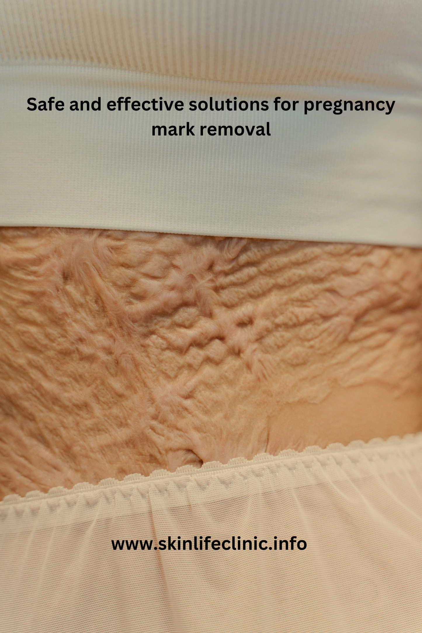 Pregnancy Mark Removal