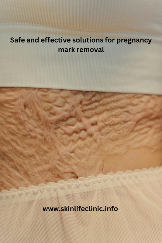 Pregnancy Mark Removal