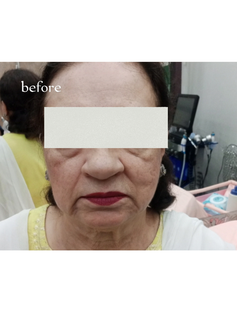 Thread Face Lift + Botox & Fillers