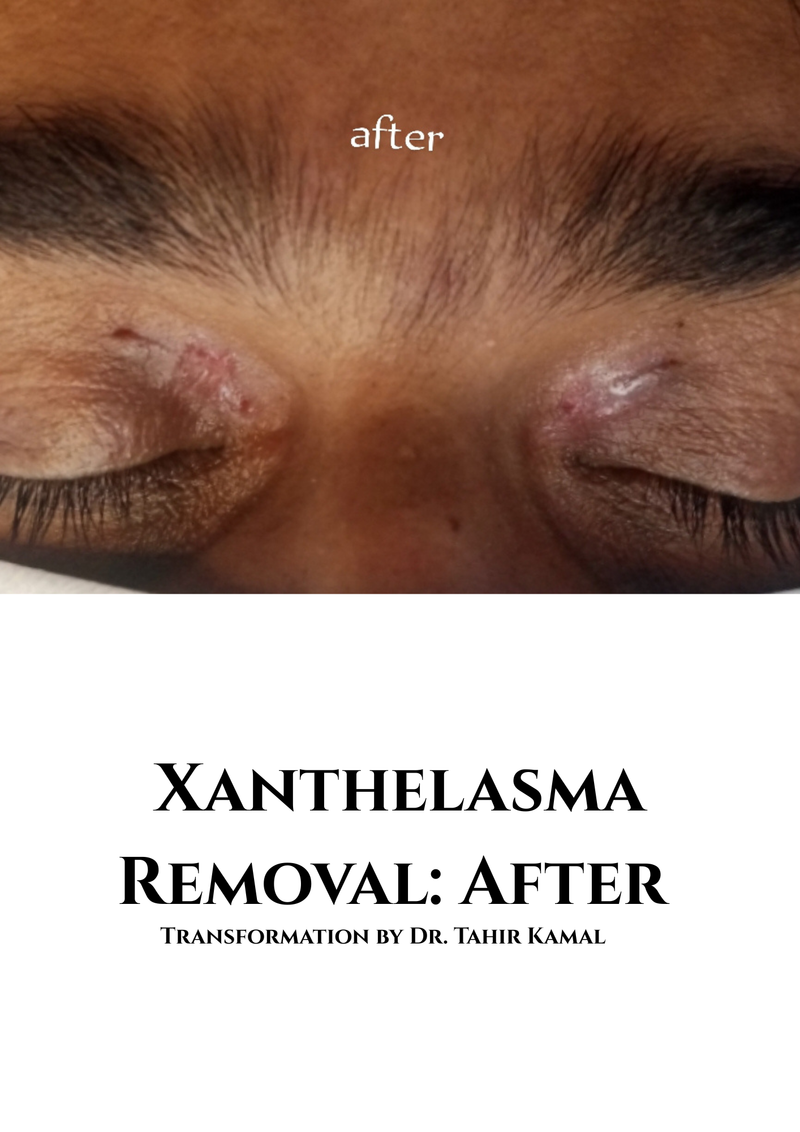 Xanthelasma