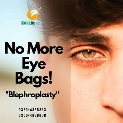 Eyebags Treatments