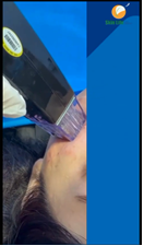 🎥 Microneedling + Radio Frequency = Total Skin Renewal