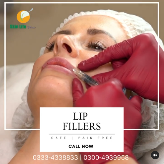 🌟 Enhance Your Smile with Lip Fillers at Skin Life Clinic! 🌟