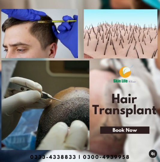 🌟 Rediscover Confidence with Hair Transplant at Skin Life Clinic! 🌟