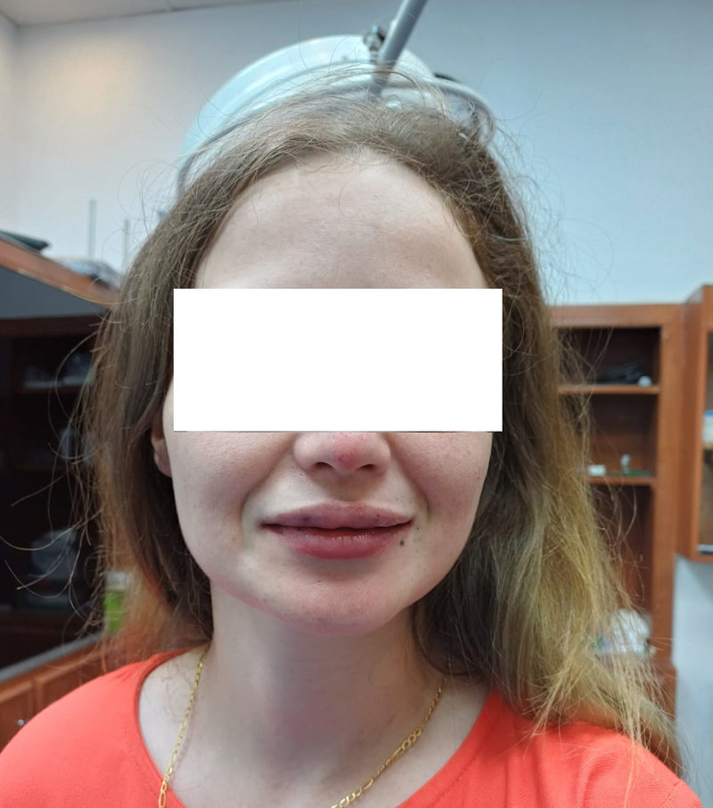 Lip Enhancement