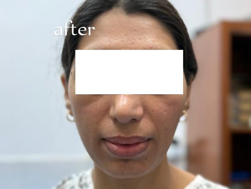 Nano Fat Treatment