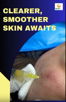 Advanced Acne Scar Treatment with Morpheus8 & PRP