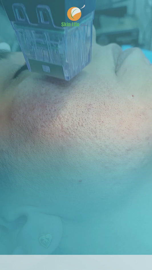 Morpheus RF Treatment for Cheek Sagging and Jawline Contouring