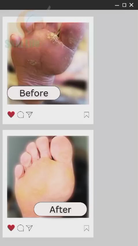 Expert Wart &amp; Skin Tag Removal at Skin Life Clinic, Lahore