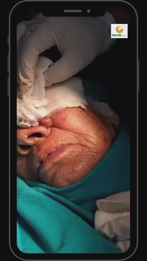 ✨ REMOVAL OF TUMOUR ON NOSE EFFECTIVELY BY DR. TAHIR KAMAL – UNDER LOCAL ANESTHESIA ✨