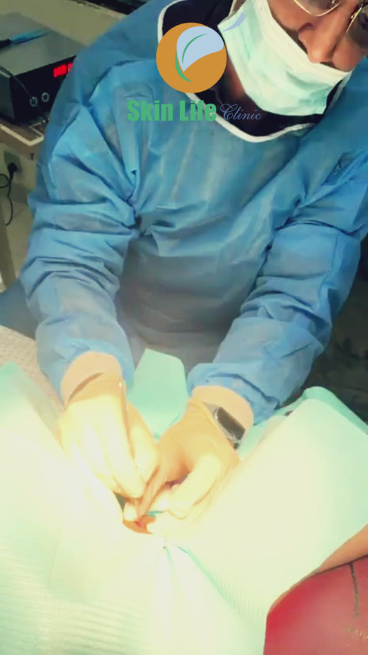 Hidradenitis Suppurativa Sinuses – Surgical Treatment