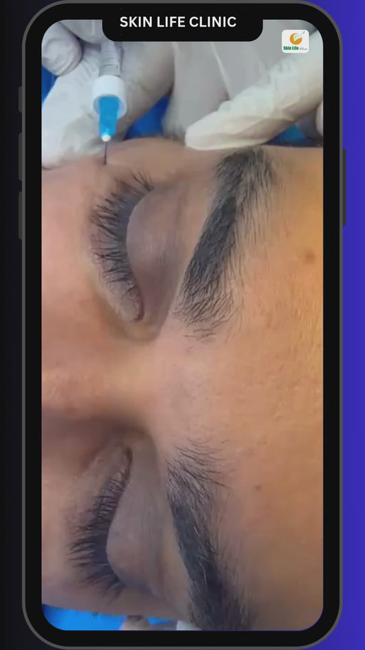 ✨ Restore Youth & Confidence with Under-Eye Filler and PRP Hair Treatment