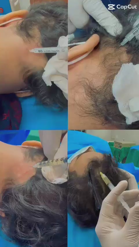 📽️ PRP with Exosomes – The Ultimate Skin & Hair Rejuvenation Treatment! ✨💉