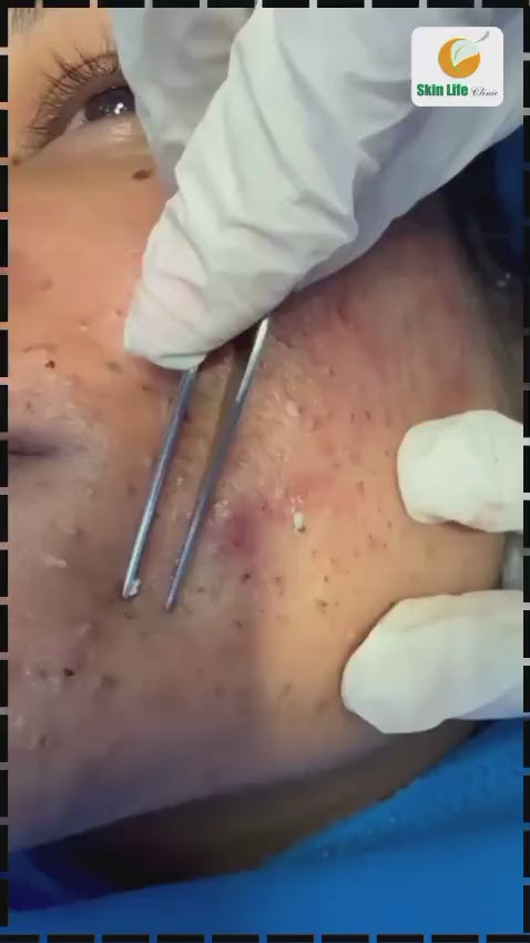 🖤 Blackhead Removal with PLEXR Plasma Technology