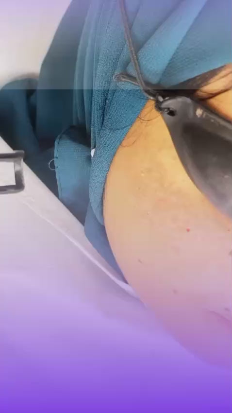 Flawless Skin Protocol CO₂ + Q Switch Laser Pigmentation Cure