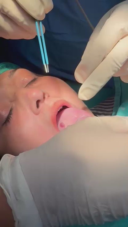 Effective Treatment for Vascular Growth on Tongue by Dr. Tahir Kamal