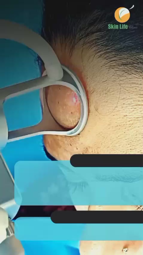 Advanced Melasma Treatment