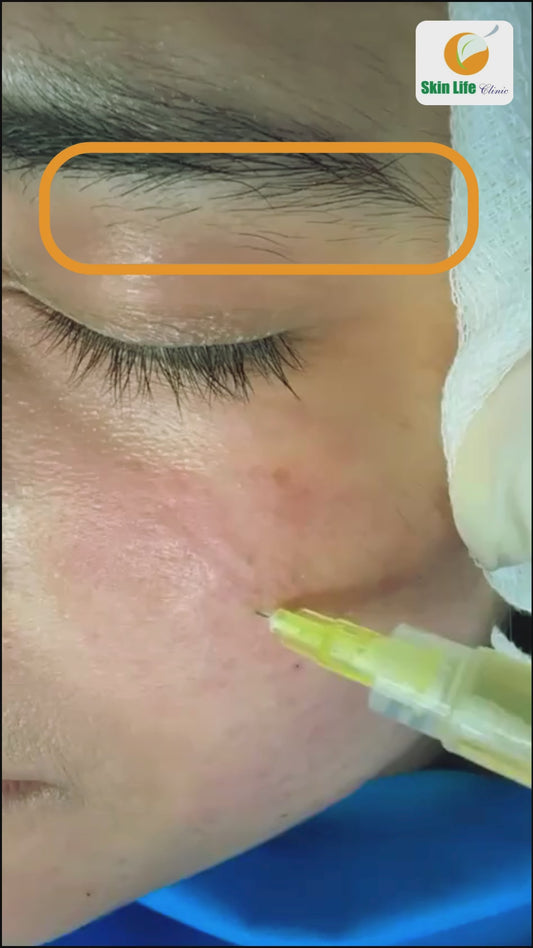 Watch Acne Scars Fade Like Never Before! 😱