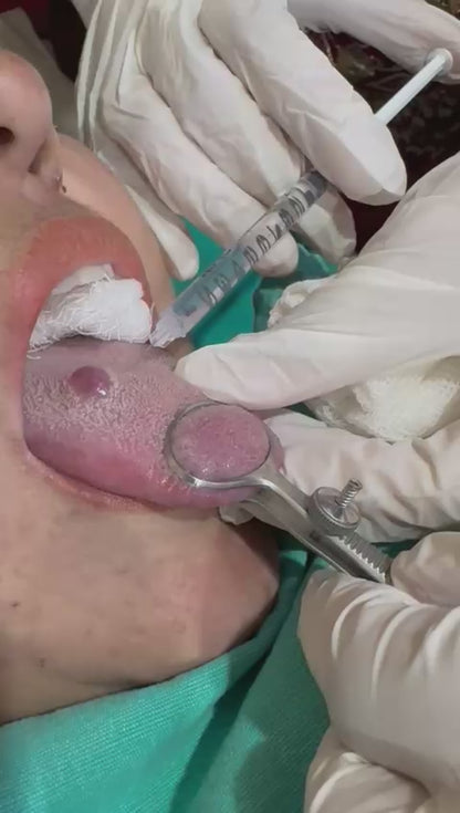 Effective Treatment for Vascular Growth on Tongue by Dr. Tahir Kamal