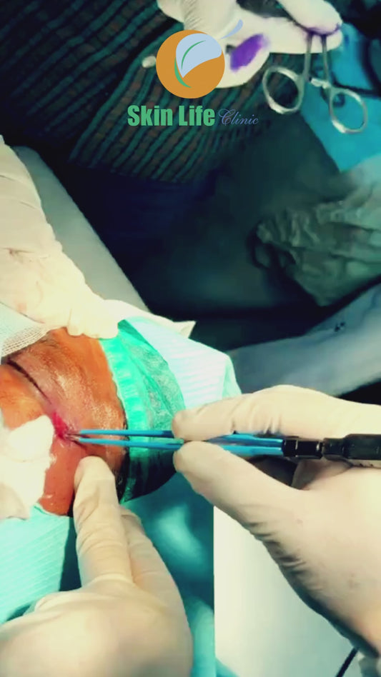 Benign Skin Tumor Removal