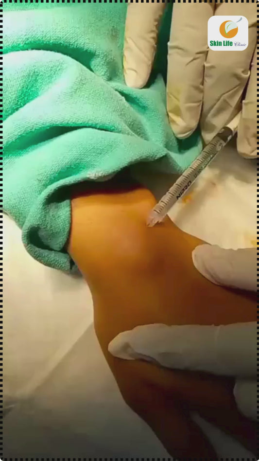 🎥 Tumor Removal from Hand – Expert Surgical Care by Dr. Tahir Kamal 🩺✂️