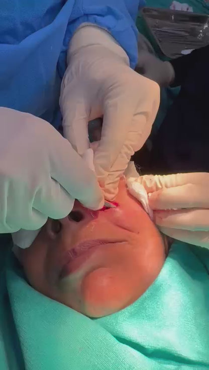 ✨ Expert Removal of Basal Cell Carcinoma: Precision & Care ✨