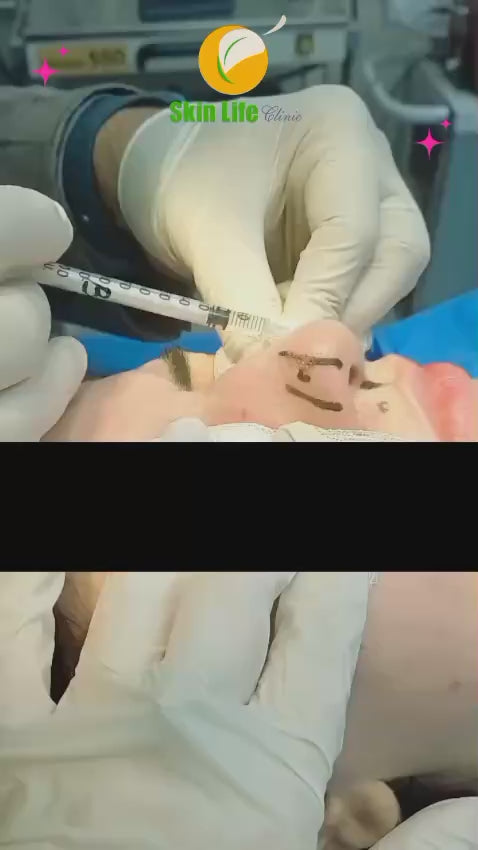 Non-Surgical Nose &amp; Chin Enhancement