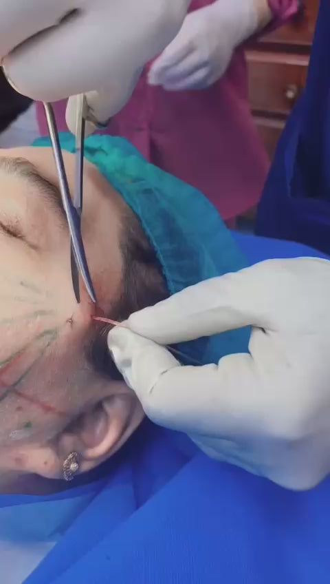 Non-Surgical Facelift with Threads by Dr. Tahir Kamal