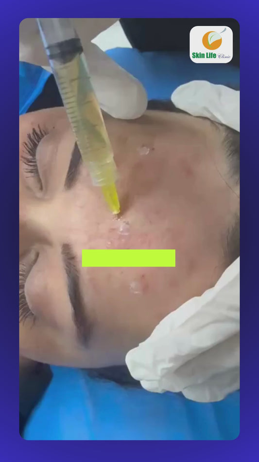 🎥✨ Erase the Scars, Reveal the Glow – PRP Acne Scar Treatment! ✨🎥