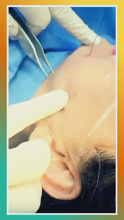 Non-Surgical Thread Facelift in Lahore