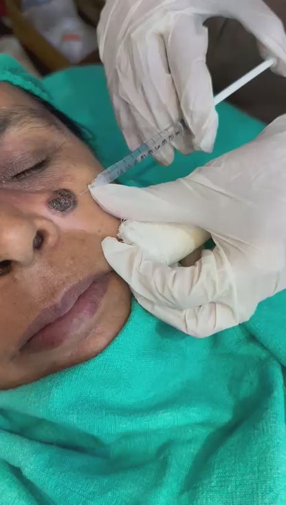✨ Expert Removal of Basal Cell Carcinoma: Precision & Care ✨