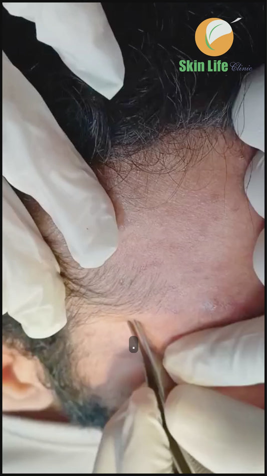 Advanced Acne and Scar Treatment with Plexr CO₂ Laser Rejuvenation