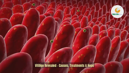 ✨ Vitiligo – Restoring Confidence, One Patch at a Time! ✨