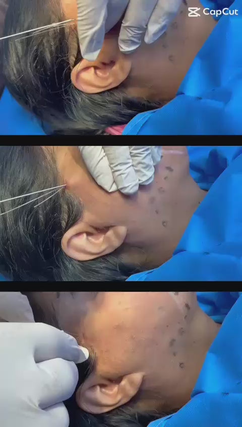 📽️ Experience the Magic of a Non-Surgical Facelift with Threads! ✨💉